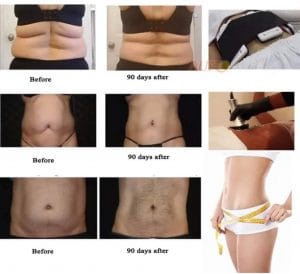 6 in 1 Cavitation Machine Before and After Photos