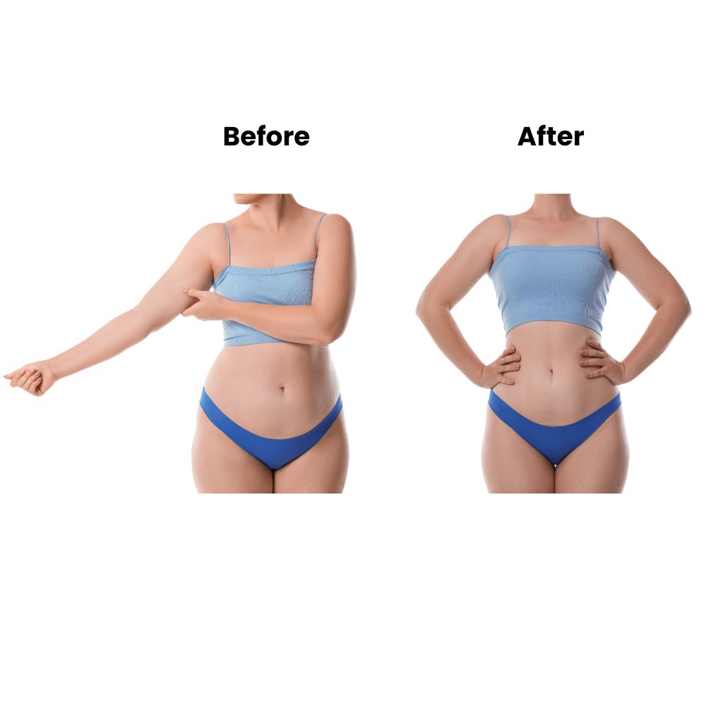 4 in 1 cavitation machine before and after results